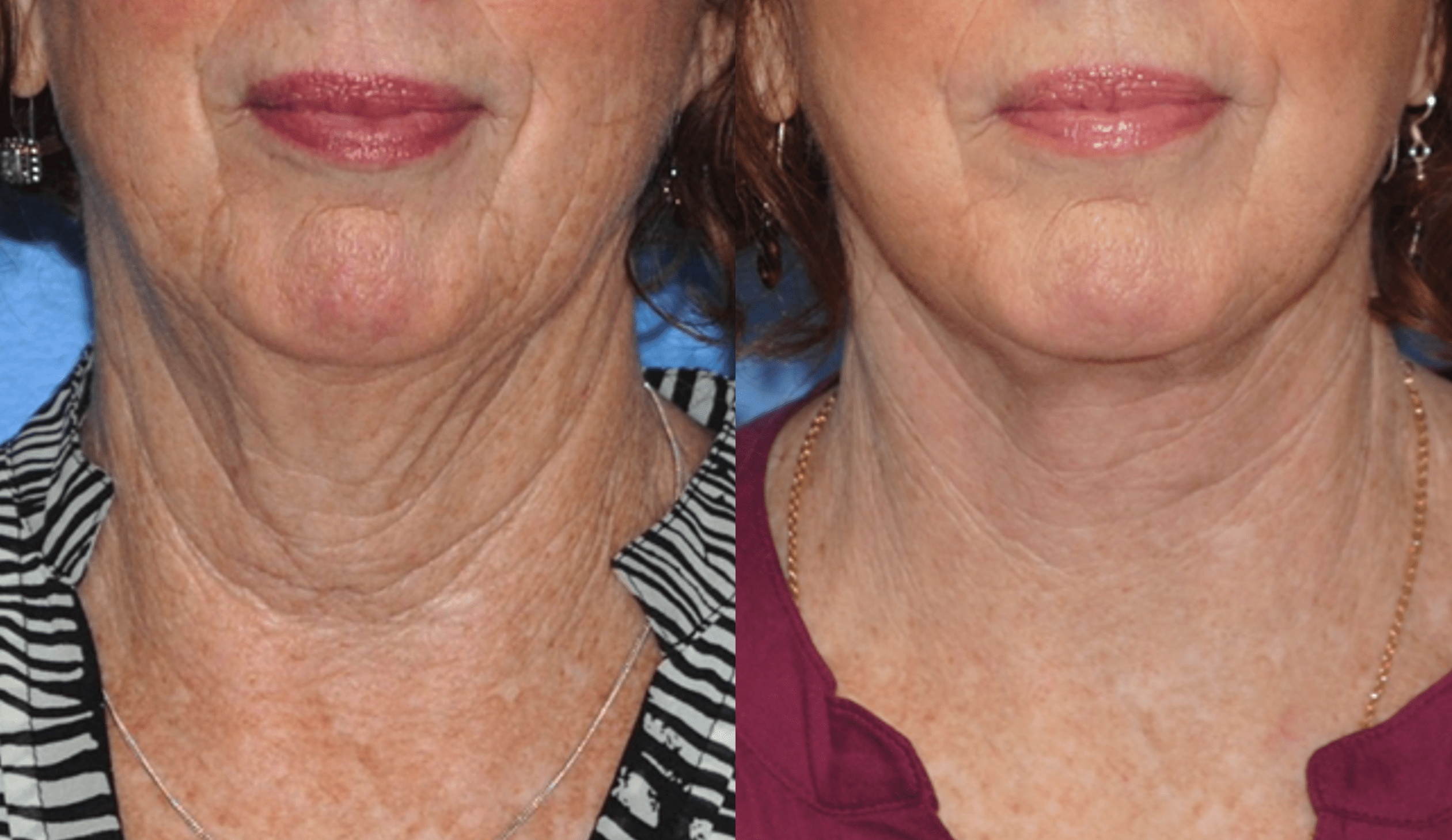The Lower Face Neck Lift Brian P Dickinson M D