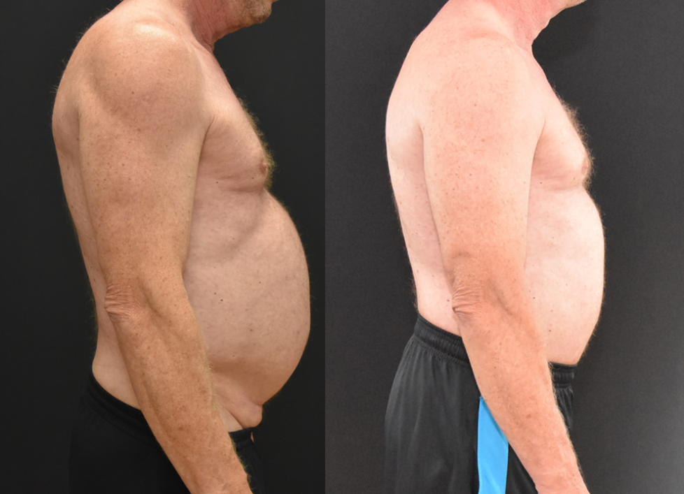 Abdominoplasty-Before-and-After-Side-Profile