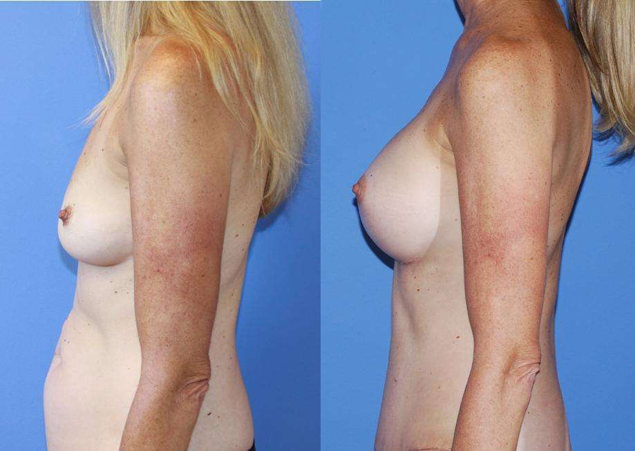Breast-Augmentation-Abdominoplasty