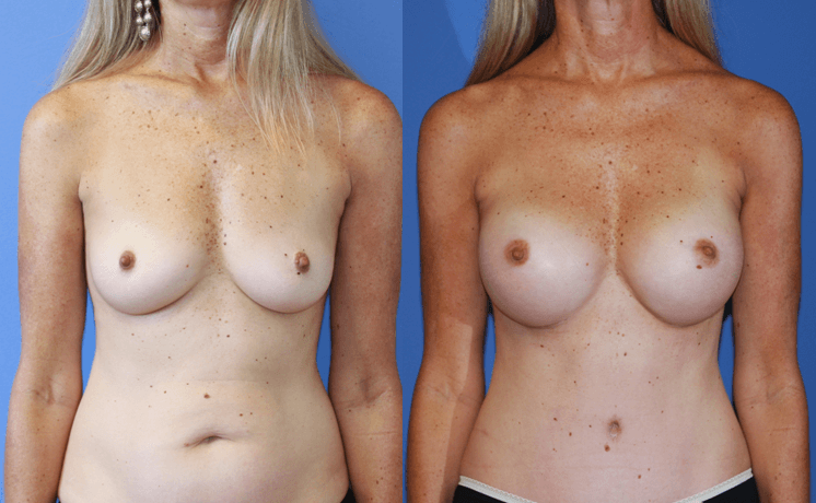 Breast-Augmentation-Dickinson-Excellent-Results-Newport-Beach