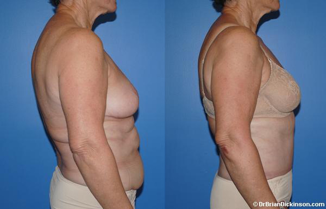abdominoplasty_before_after