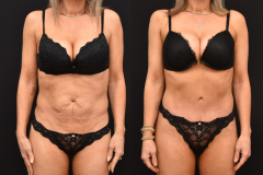 1_Abdominoplasty-Newport-Beach-CA-Brian-P.-Dickinson-M.D
