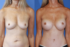 1_Breast-Augmentation-Dickinson-Excellent-Results-Newport-Beach