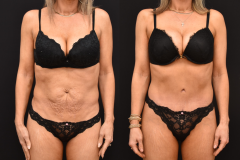 Abdominoplasty-Newport-Beach-CA-Brian-P.-Dickinson-M.D