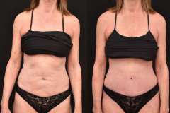 Abdominoplasty-Newport-Beach-CA-Elite-Abdominoplasty-Brian-P.-Dickinson-M.D