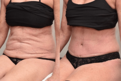 Abdominoplasty-Sitting-Photograph-Brian-P.-Dickinson-M.D