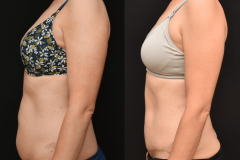 CT-Before-and-After-Abdominoplasty