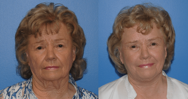 Facelift Surgery Before and After
