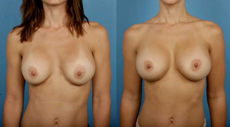 Breast Augmentation Silicone Breast Implants