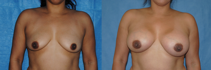 Areolar Incision Breast Augmentation