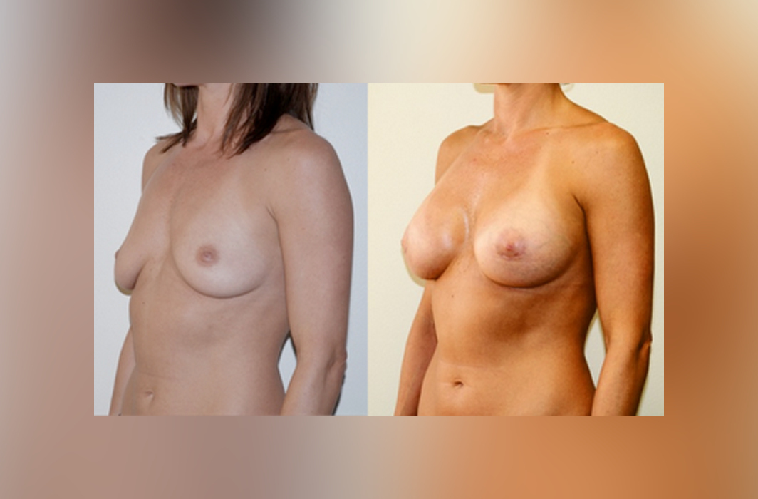 Subglandular_Silicone-Breast-Implant