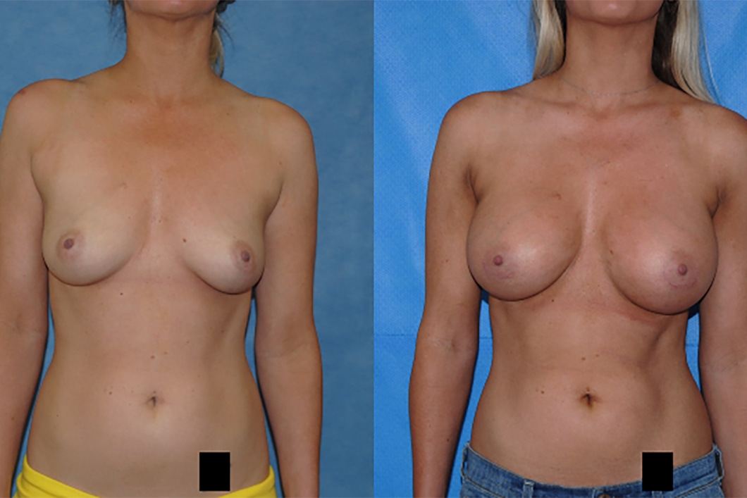 Breast-Augmentation-Newport-Beach-Silicone-Implants-Brian-Dickinson