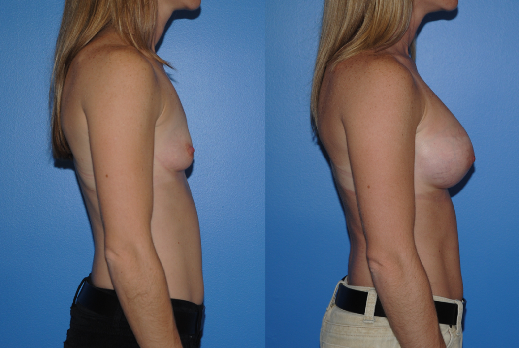 Breast Augmentation-Orange County-Dickinson-Newport Beach-Breast Implants