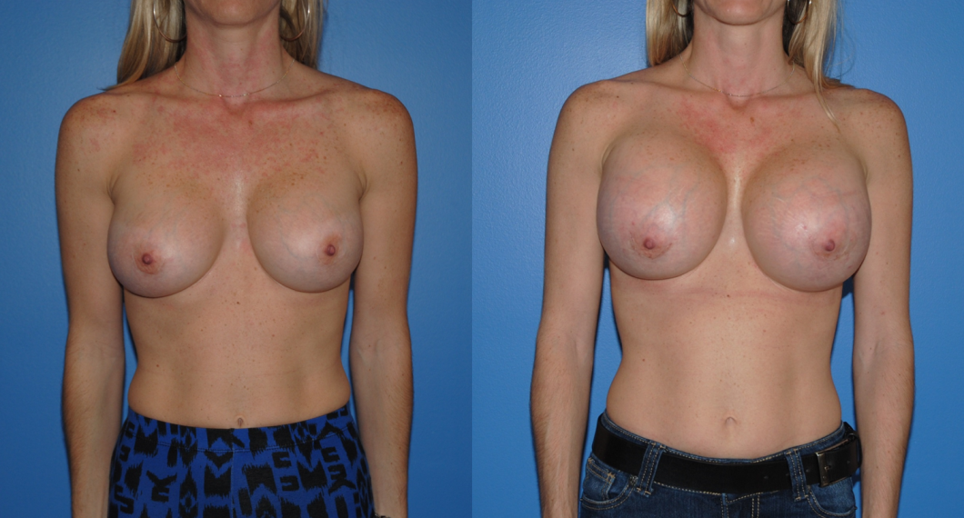 Breast Augmentation-Revision-Newport Beach-Orange County