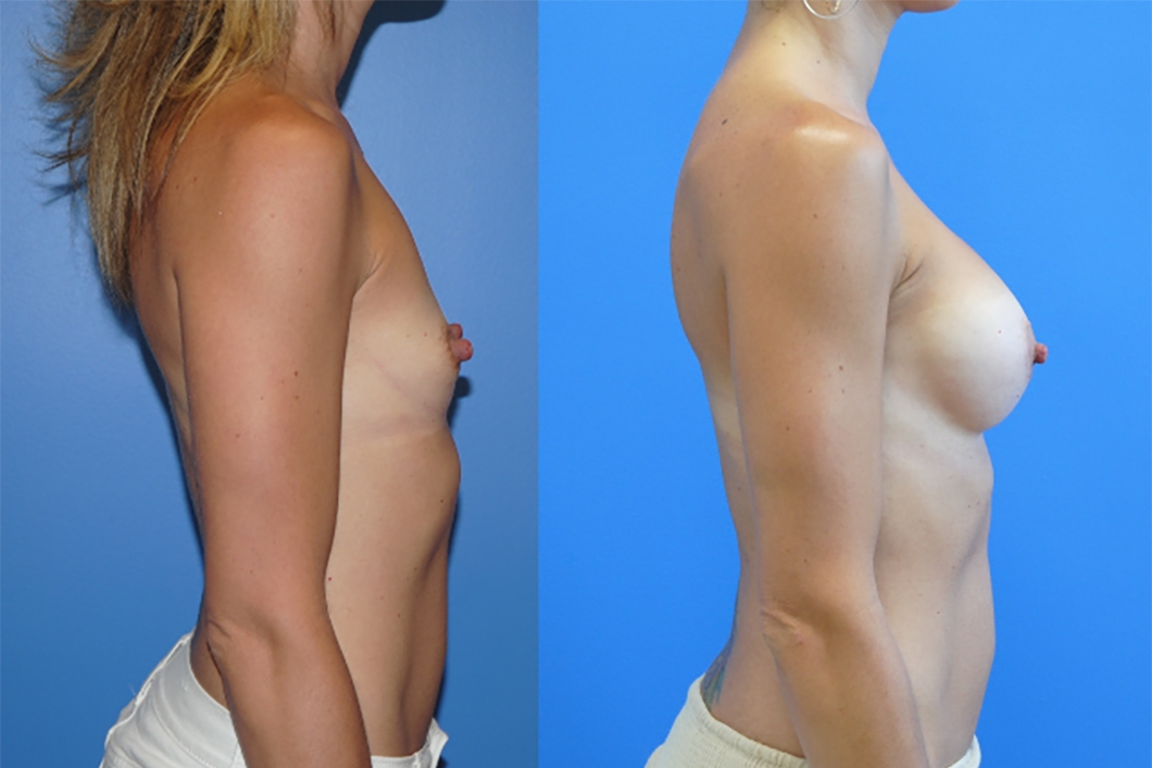 Breast-Augmentation-Silicone-Implants-Areola-Incision