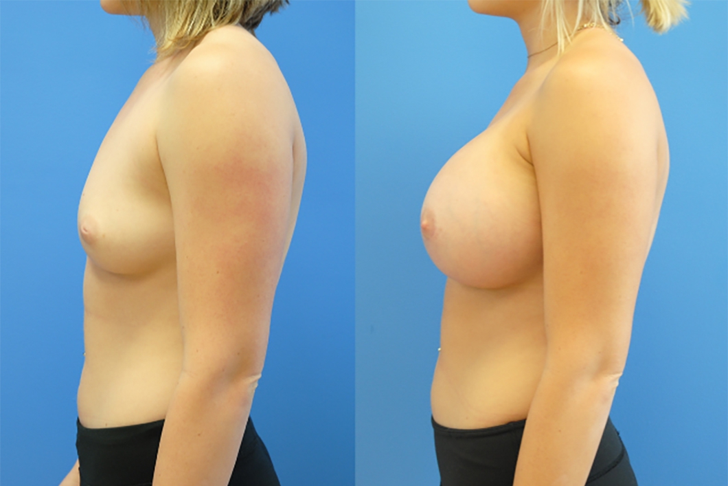 Breast-Augmentation-Silicone-implants-before-and-after
