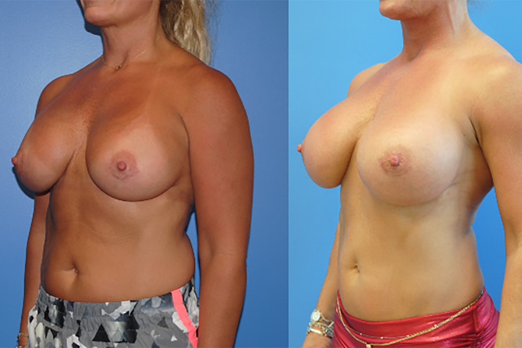 Breast-Augmentation-plastic-surgeon-newport-beach-brian-dickinson
