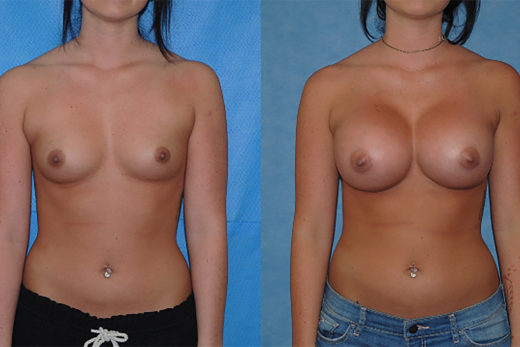 Breast-Augmentation-surgeon-OC