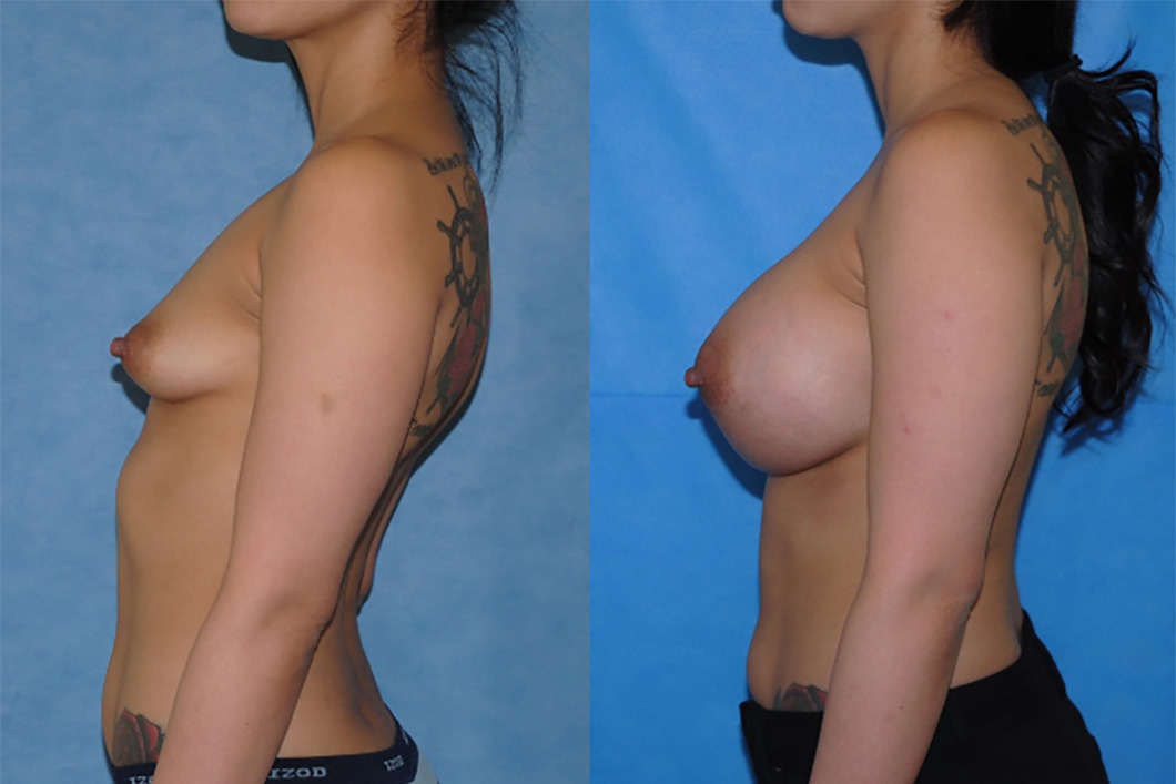 Tuberous-Breast-Deformity-OC-dr-brian-Dickinson