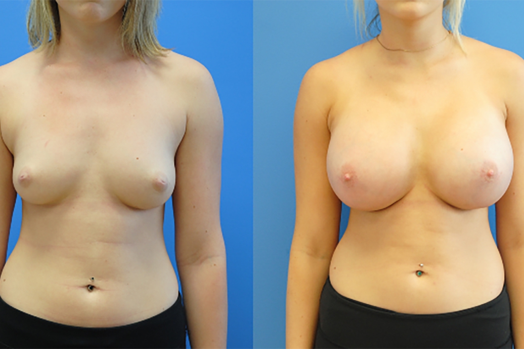 before-and-after-Breast-Augmentation-Silicone-implants