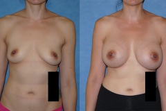 Before-and-After-Breast-Augmentation-doctor-Brian-Dickinson