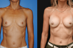 Breast-Augmentation-Longevity-13-years-1