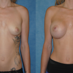 Breast Augmentation-Orange County-Brian Dicknson MD-Newport Beach-Silicone Implants