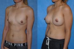 Breast-Augmentation-Orange-County-Newport-Beach