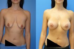 Breast-Augmentation-dr-Dickinson-Newport-Beach