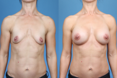 Elite-Athletes_Breast-Augmentation_Newport-Beach_Breast-Implants