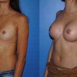 Transax-Breast-Augmentation