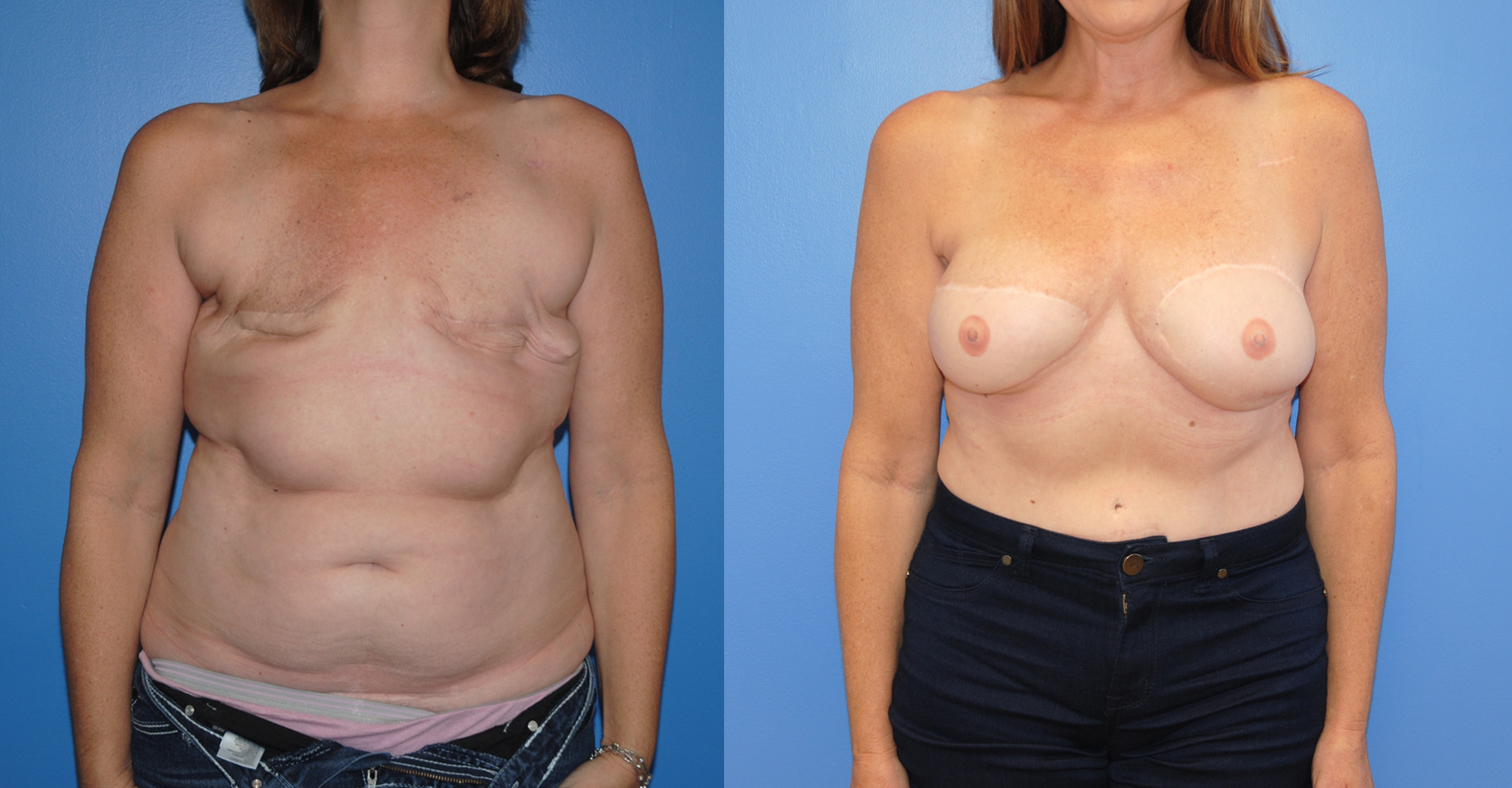 3D-Tatoo-DIEP-Breast-Reconstruction