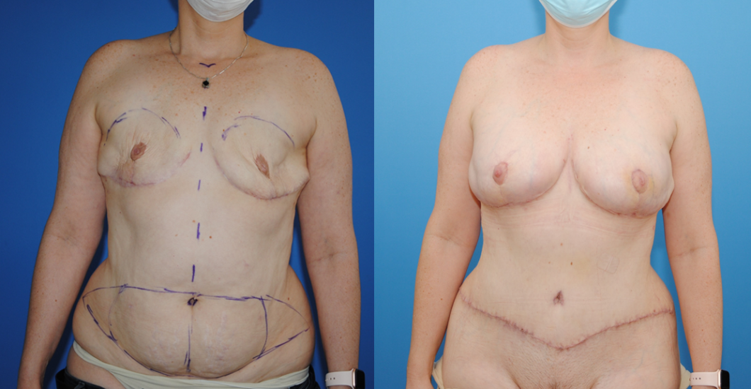 Bilateral-DIEP-Flap-Breast-Reconstruction-Brian-Dickinson-M.D.
