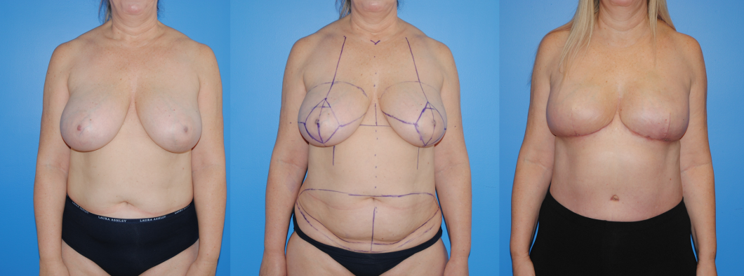 Bilateral-DIEP-Flap-Breast-Reconstruction-PALBB-2