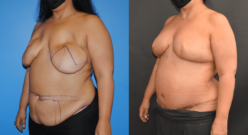 Bilateral-DIEP-Flap-Breast-Reconstruction-after-Implant-Removal-Brian-P.-Dickinson-M.D.