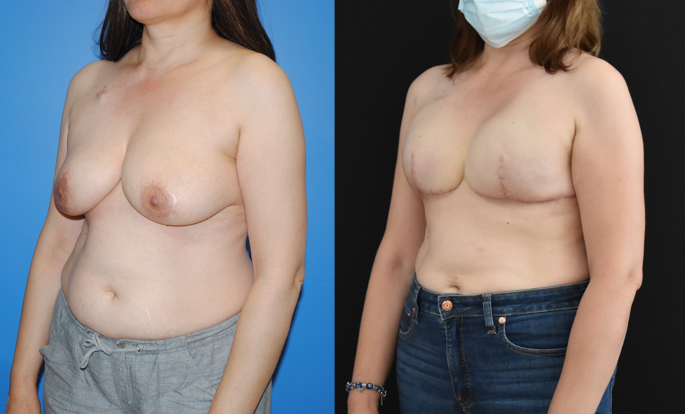 Bilateral-Mastectomy-Recoonstruction-Expander-Implant-Reconstruction-Three-Quarter-View