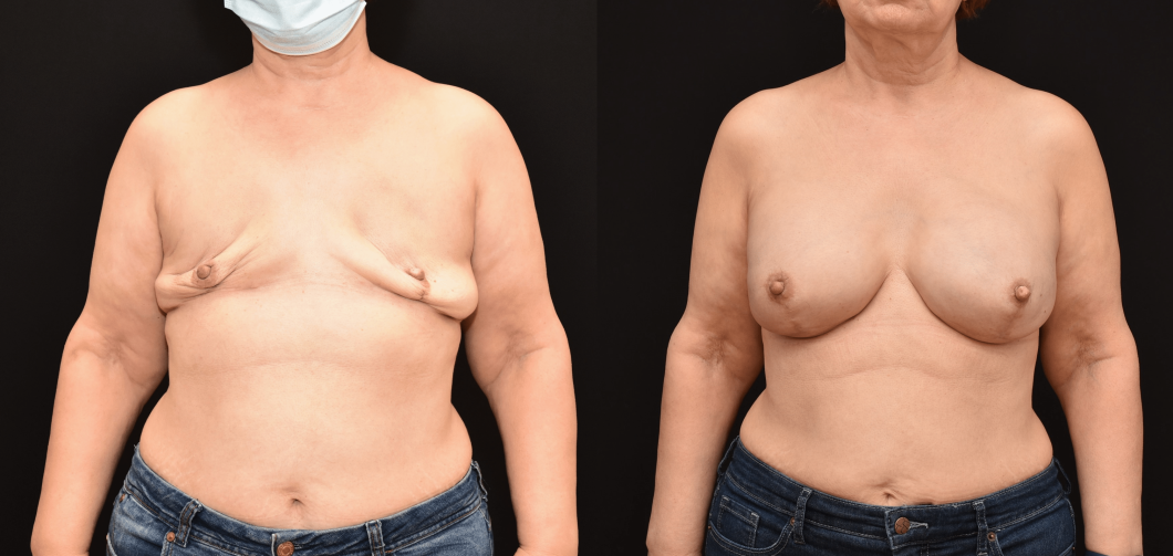 Breast-Implant-Reconstruction-Following-Bilateral-Mastectomy