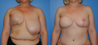 Breast Reconstruction with autologous tissue