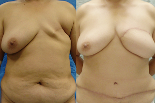 Breast Reconstruction with DIEP Flaps