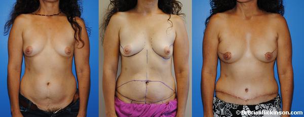 Early Post-Operative Bilateral DIEP Breast Reconstruction