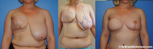 DIEP Flap Breast Reconstruction by Dr. Dickinson in Newport Beach