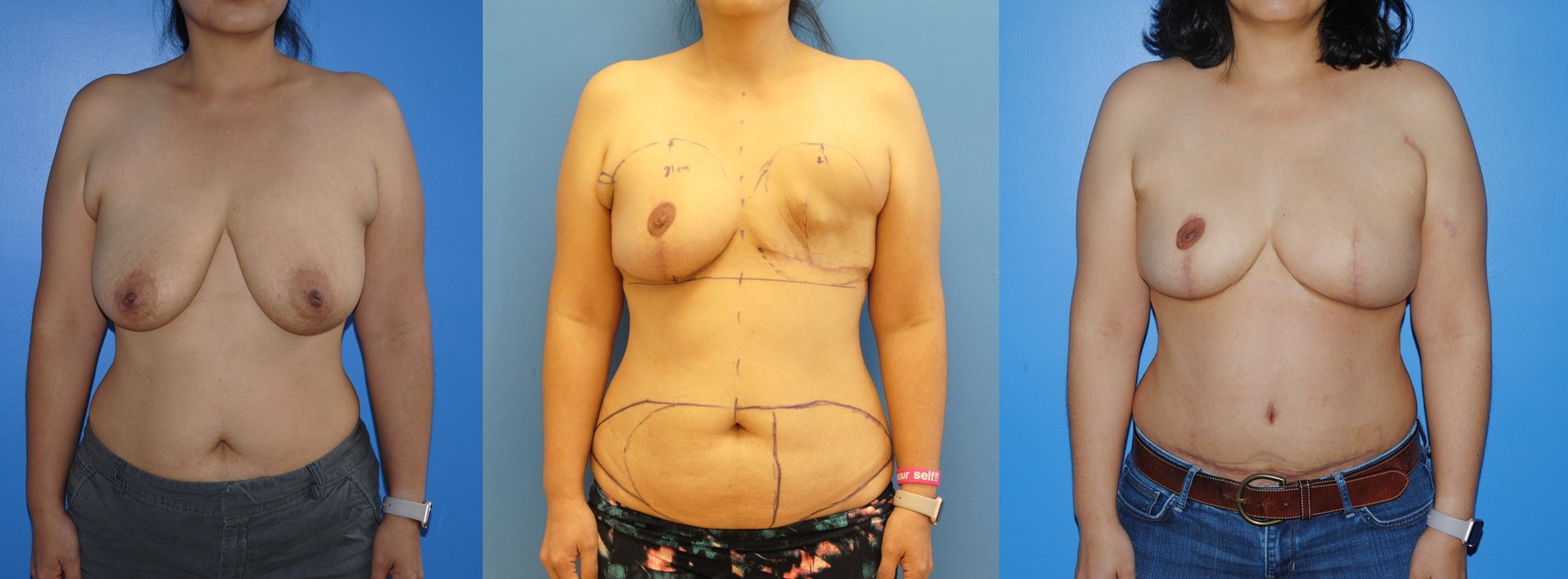 DIEP Flap Breast Reconstruction (2)