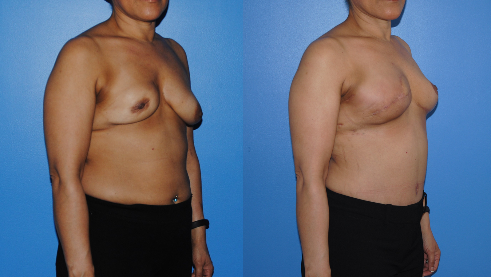 DIEP-Flap-Breast-Reconstruction-Oblique-Breast-Reconstruction