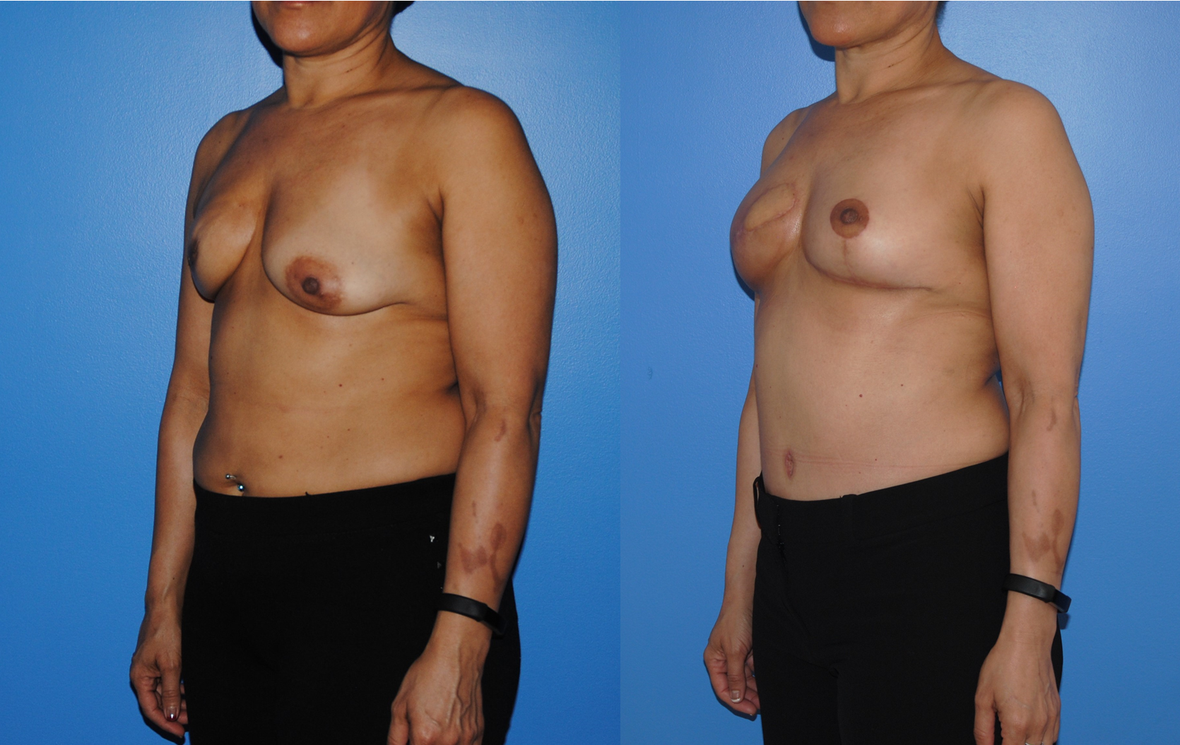 DIEP-Flap-Breast-Reconstruction-Oblique