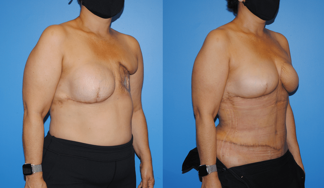 DIEP-Flap-Breast-Reconstruction-Post-Radiation-Therapy-Newport-Beach-Brian-Dickinson
