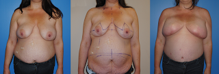 DIEP Flap Breast Reconstruction following mastectomy