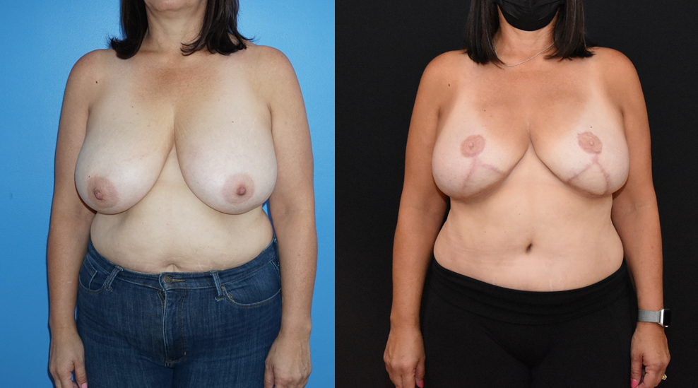 KS-DIEP-FLAP-Breast-Reconstruction