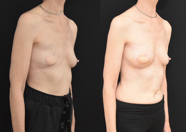 Latisimus-Flap-and-Implant-Mastectomy-Reconstruction-Three-Qurter-View