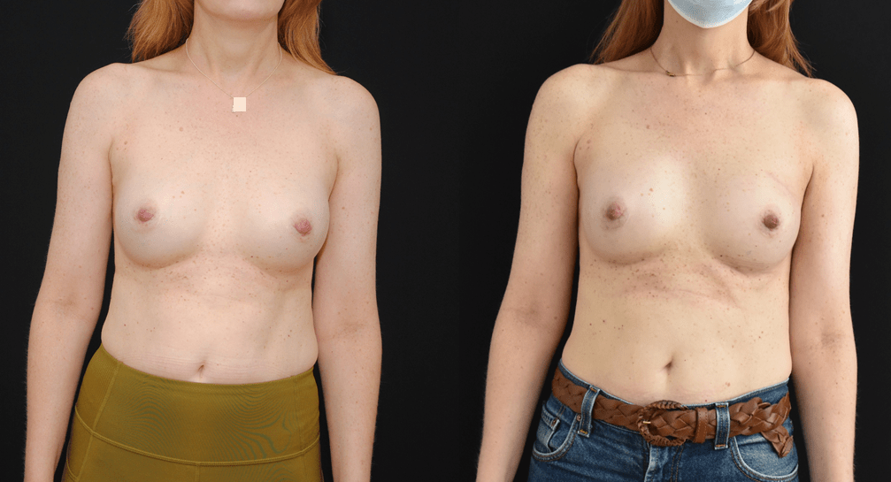 Oncoplastic-Breast-Reconstruction-IORT-and-Mammary-Prosthesis
