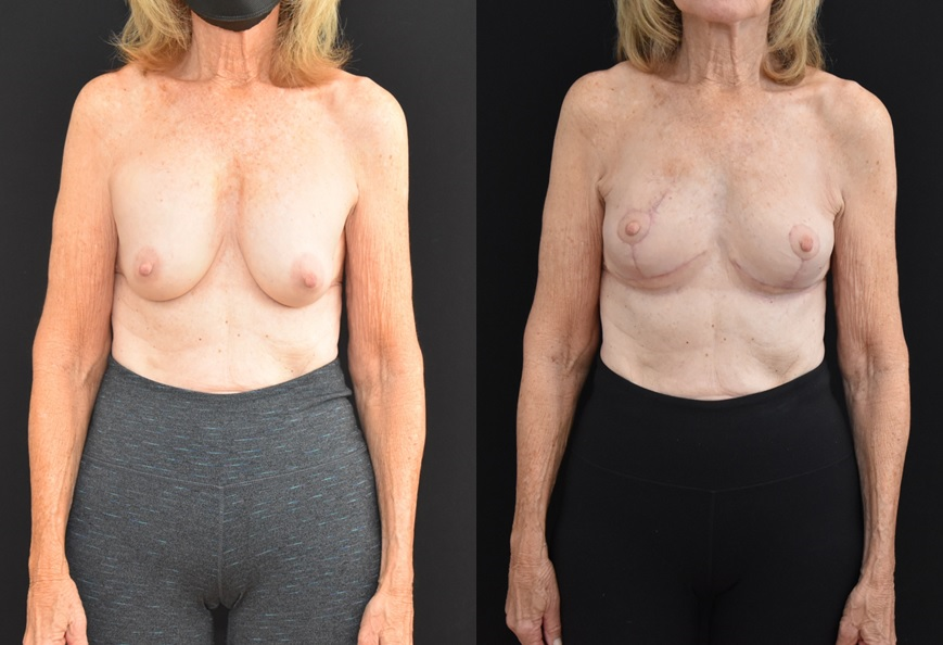 Oncoplastic-Breast-Reconstruction-IORT-and-removal-of-mammary-prosthesis.